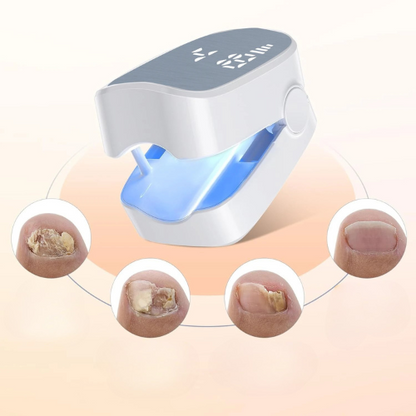 EllaLuxe NailClean Pro™ – Traitement Laser Anti-Mycoses Professionnel à Domicile